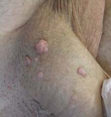 Erkekte HPV