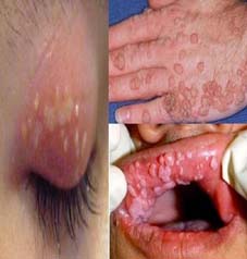 HPV Enfeksiyonu Belirtileri